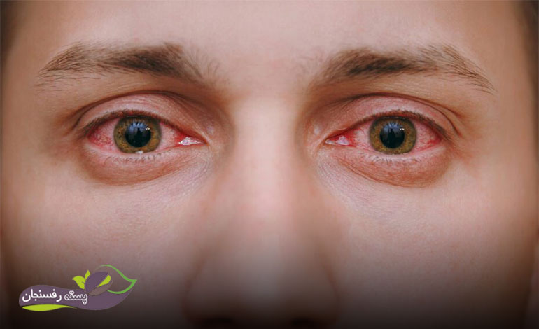 قرمزی و تورم چشم ها از جمله عوارض شاهدانه